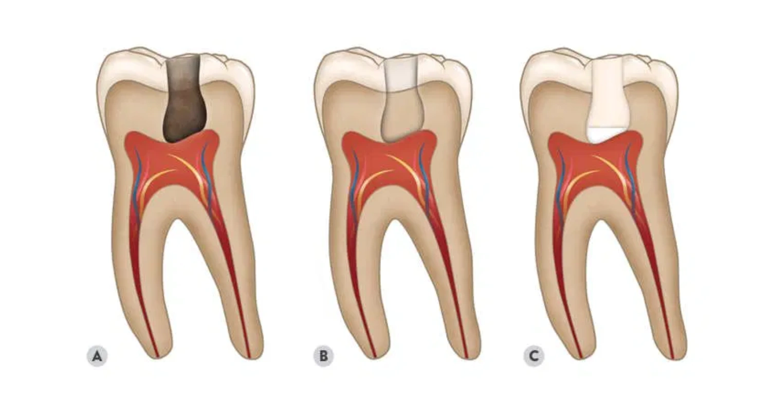 pulp cap dental